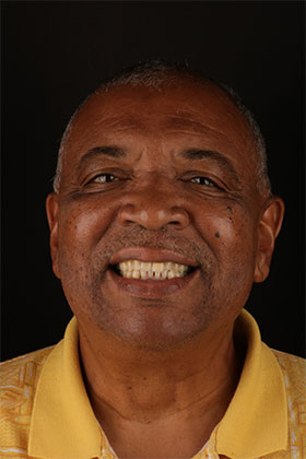 Full-arch smile restored with All-on-4 implants, radiating confidence and happiness.